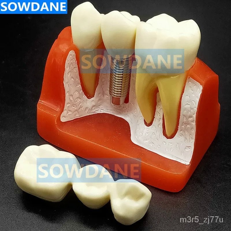Dental Implant Model With Crown Bridge And Removeable Crowns For Education-Normal