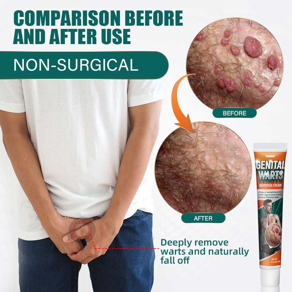 Private Wart Remover Cream Ointment Private Parts Care Flat Warts