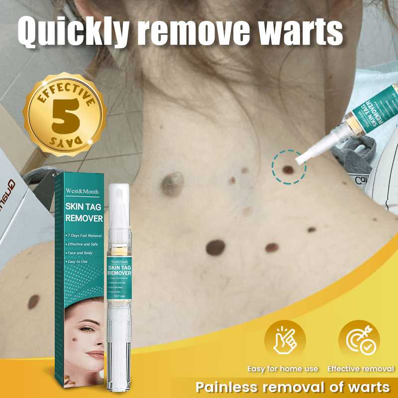 Warts Remover Original Removal Cream Watson Kasoy Oil Mole And Warts Skin Tag Grandeur Wartz