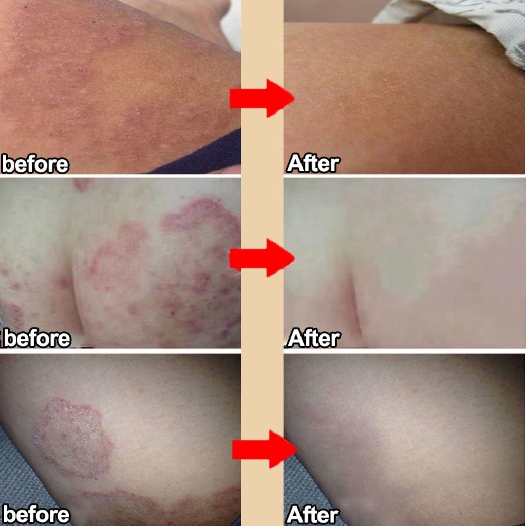 Private parts antiitch cream Cure all itching Fungal cream remove