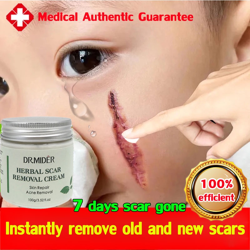 The scar is gone in 3 days 200g Scar Remover cream for kids 100