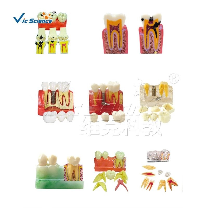 tooth model teeth practice dental caries model, 10 times l dental ...