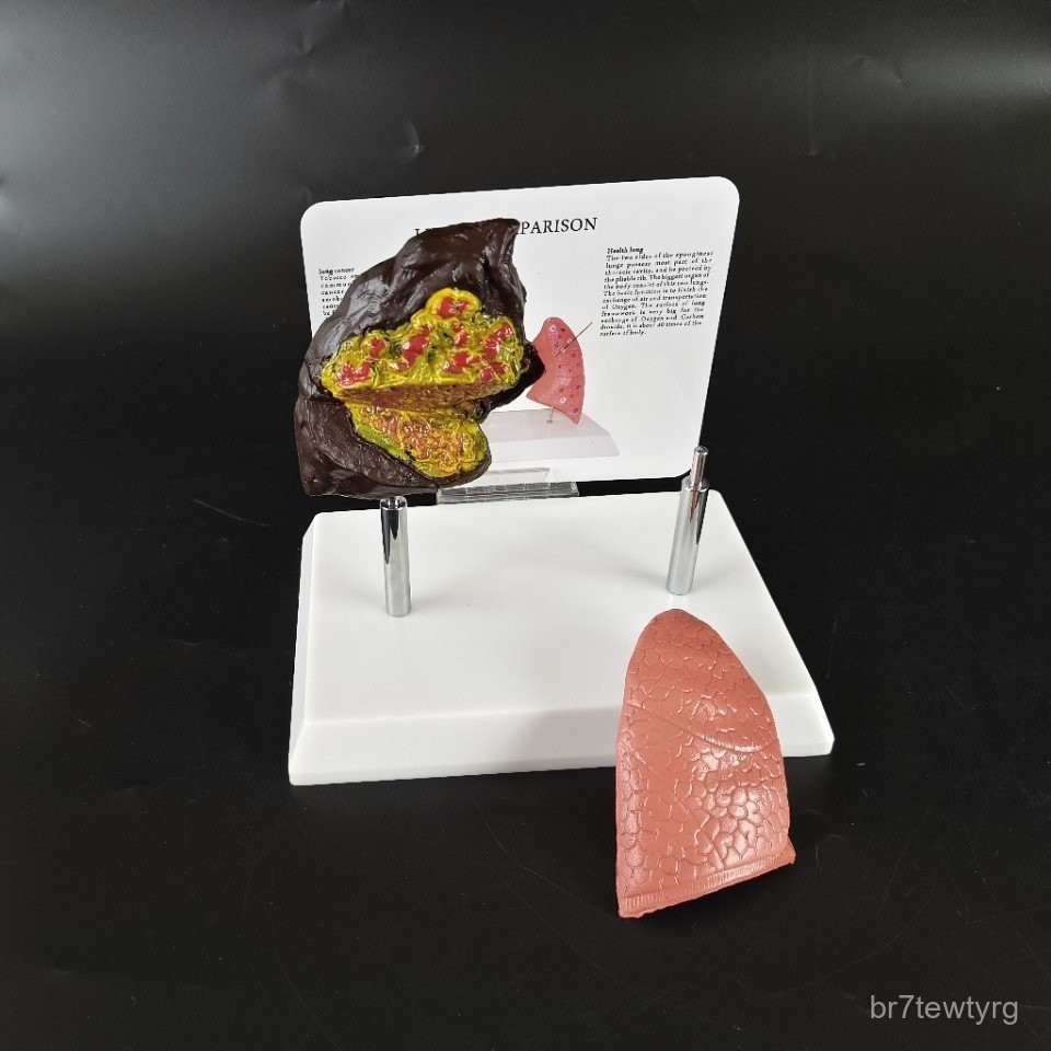 AYR1 Model Normal Medical Comparison Lung Health Care Teaching Display ...