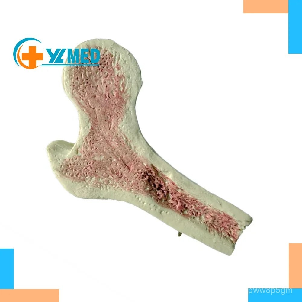 Factory medical Osteoporosis model of Human Femur Anatomical internal ...