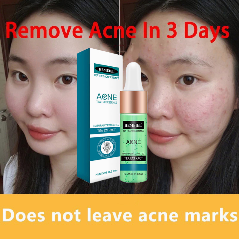 HEMEIEL Tea Tree Acne Remover Acne Treatment Serum Pang Tanggal Ng