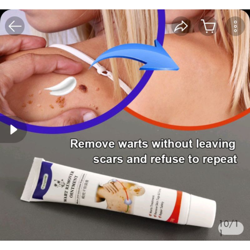 DUHOE WART REMOVER OINTMENT/20GWarts Treatment/Remove Skin Tags&Corns