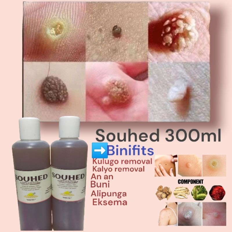 ️SOUHED 300ML | KULUGO REMOVAL | KALYO REMOVAL | Shopee Philippines