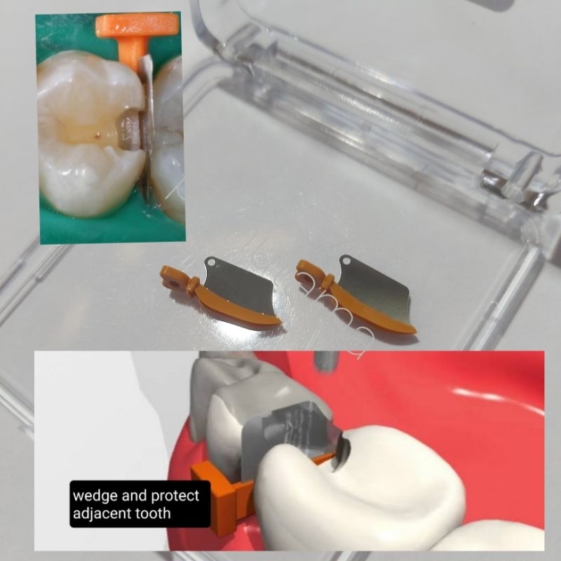 dental interproximal tooth shield dental wedge with protector for