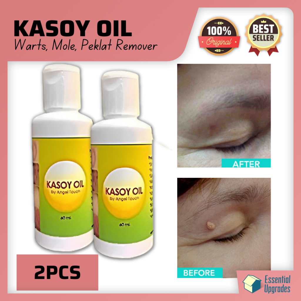 Original KASOY OIL Pantanggal ng Warts, Nunal, Skin Tag Kulugo at Kalyo ...