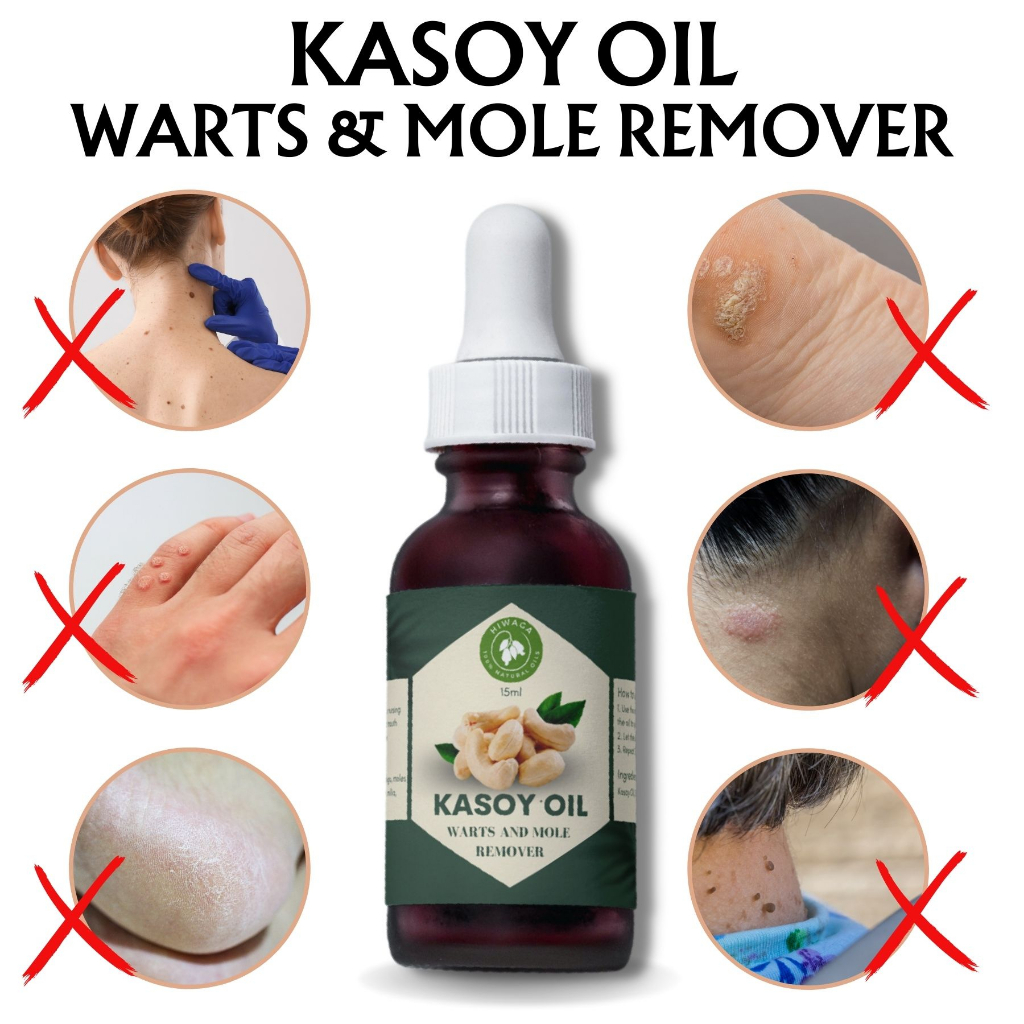 [Hiwaga] Original Kasoy Oil 15ml 100% Safe & Effective Warts & Mole ...
