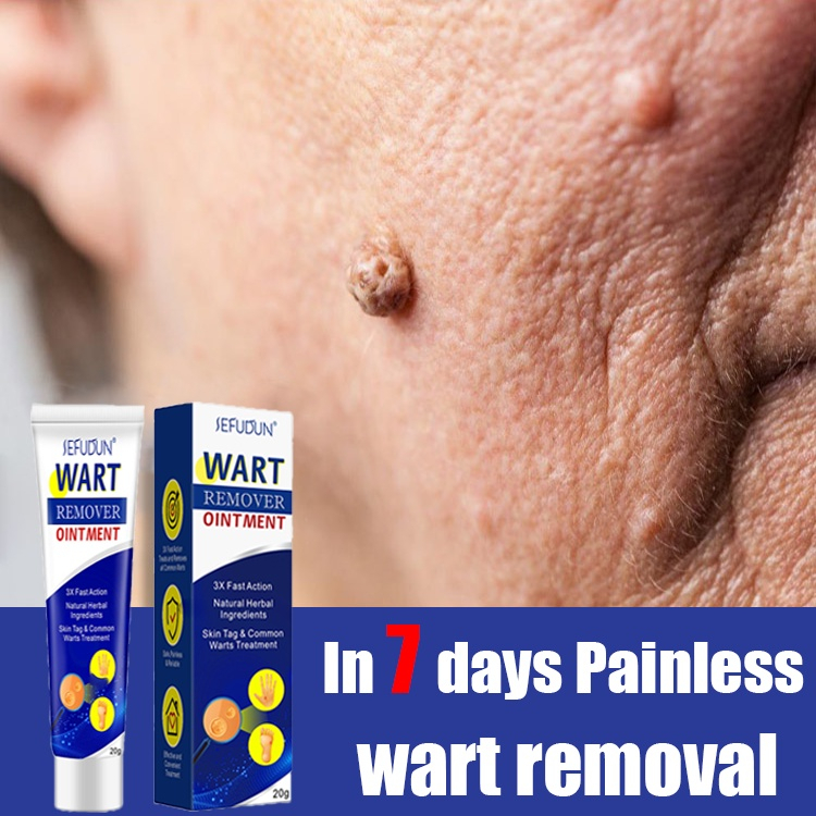 Warts Remover Cream Foot Corns Remover Cream Warts Removal Ointment To