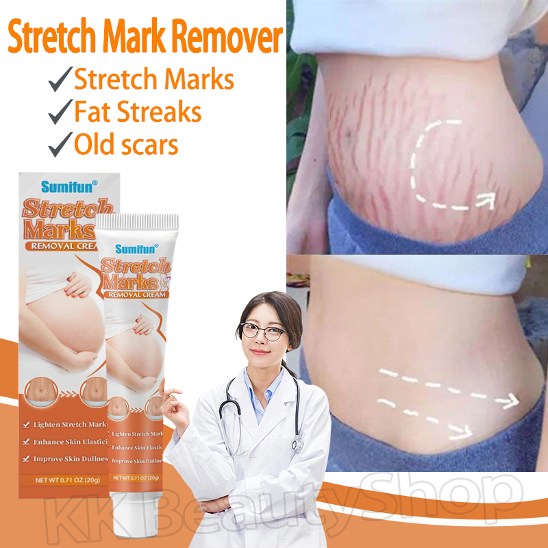 Stretch Mark Remover Scar Remover Cream For Pregnant Lighten Stretch ...