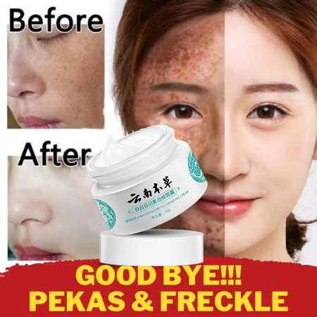 Original Japanese Melasma Cream Yunnan Herbal Whitening Freckle Cream ...