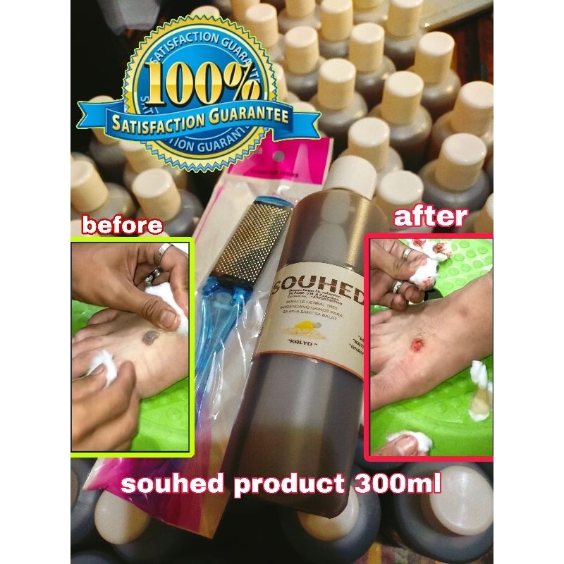 kulugo removal | SOUHED 300ML | Shopee Philippines