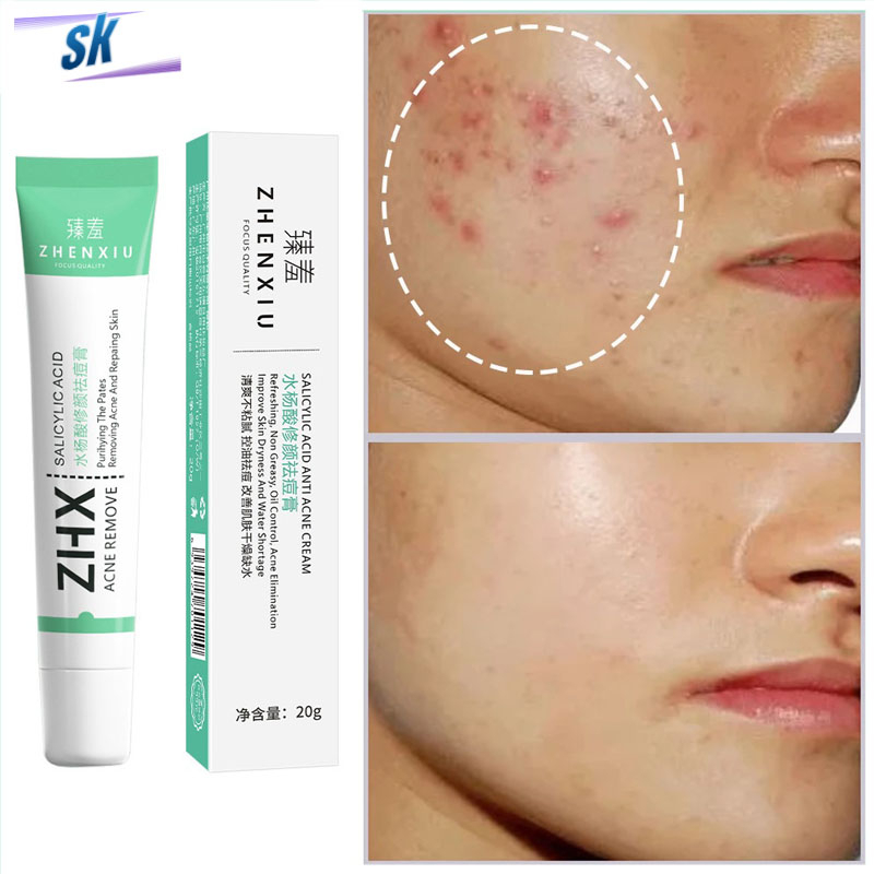 Salicylic Acid Acne Cream Remove Blackhead Oil Control AntiAcne Treatment Repair Pimple Acne