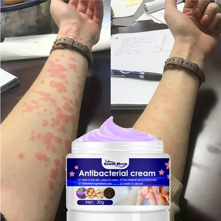 Herbal Cream Antifungal Psoriasis Cream Eczema Urticaria Treatment