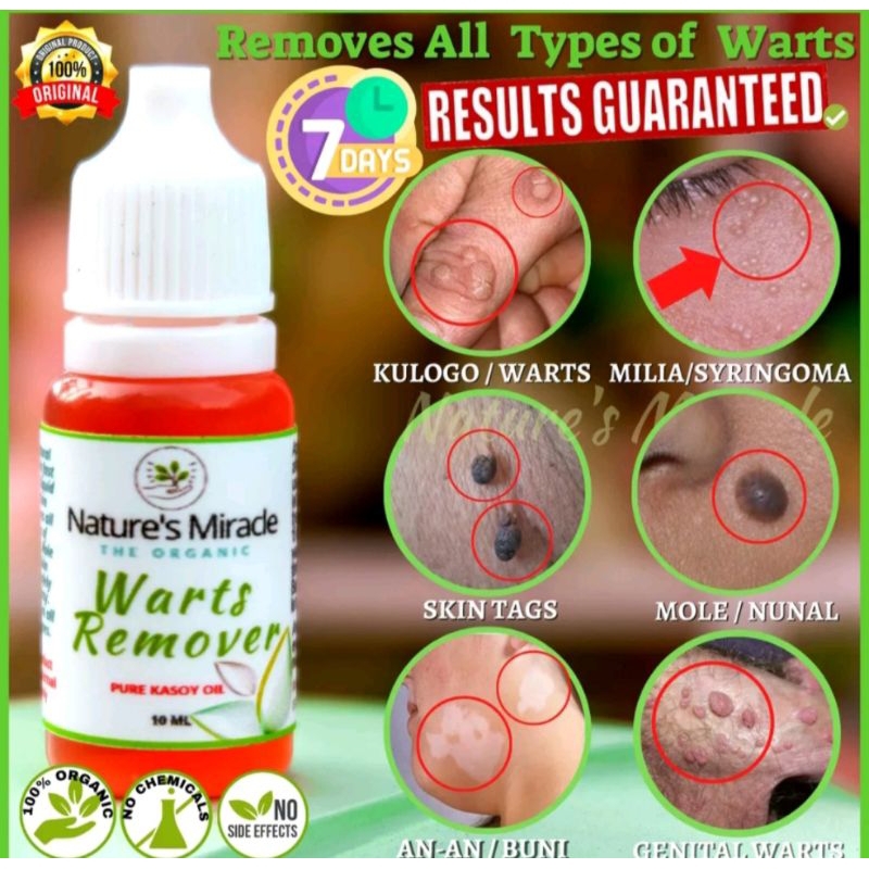 Warts Remover (Nature's Miracle) Shopee Philippines