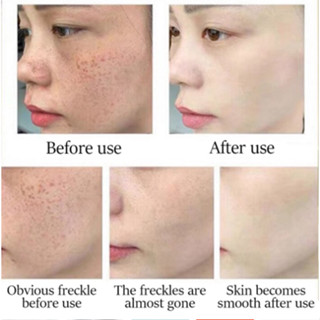 Original Japanese Melasma Cream Yunnan Herbal Whitening Freckle Cream ...