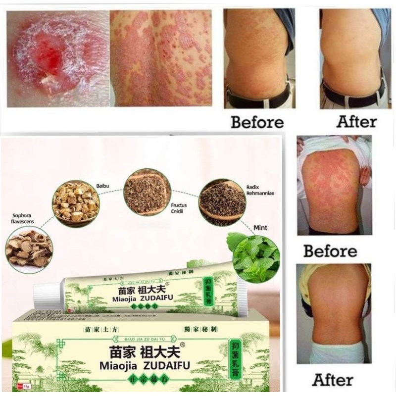 Original MiaoJia Zudaifu Skin Herbal Psoriasis Dermatitis Eczema ...