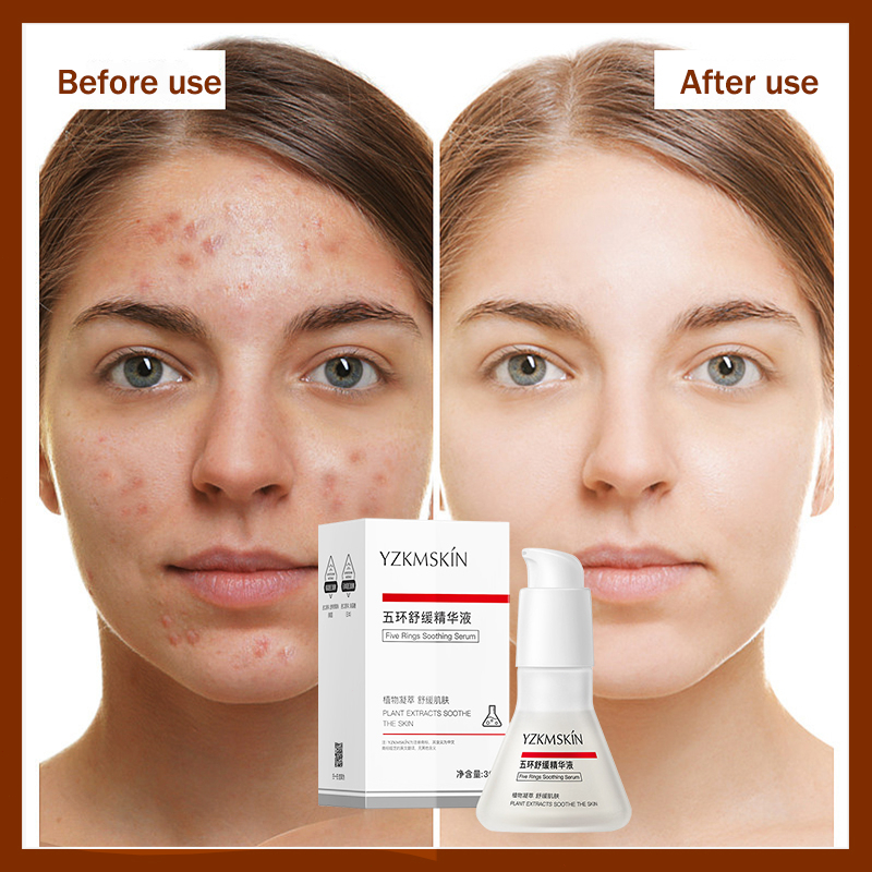 Acne Repair Moisturizing Brightening Facial Serum 30ml Acne Removing