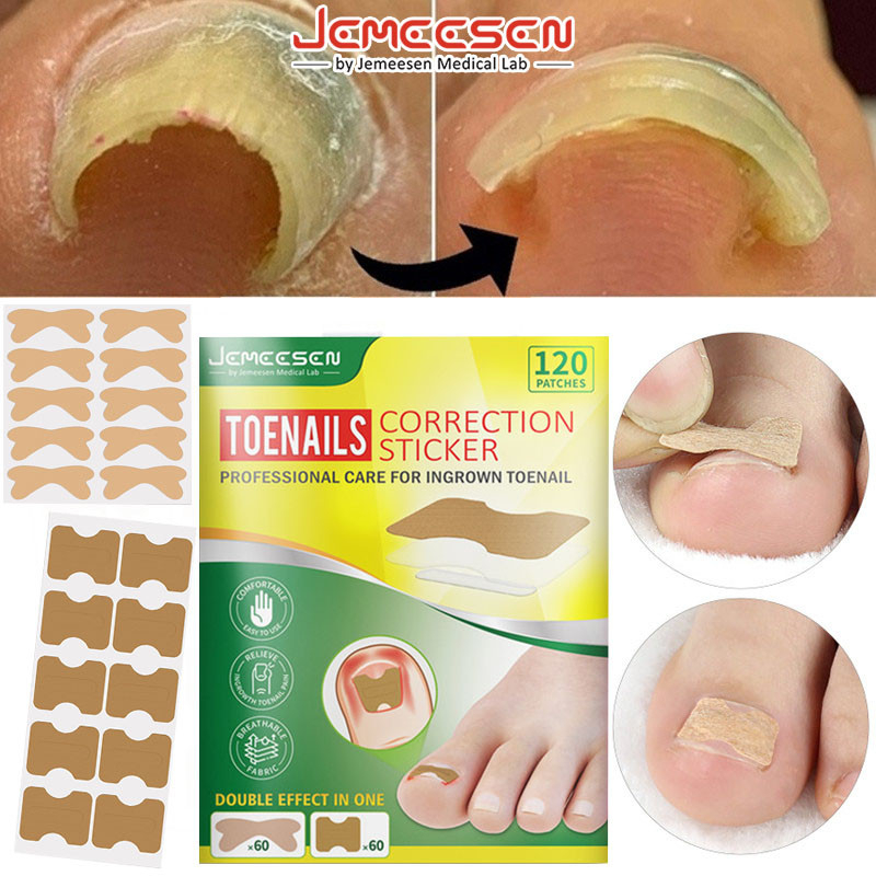 Jemeesen 120PCS Toenail Correction Sticker Nail Paronychia Treatment ...