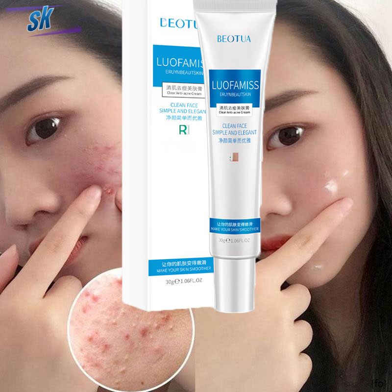 Acne remover cream Pimple eraser Pimple marks remover Pore minimizer
