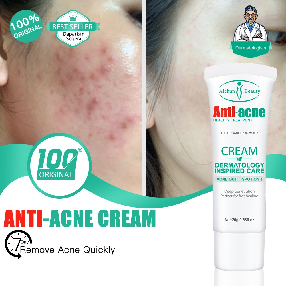 【BUY 2 GET 1 FREE】original Anti Acne Cream Treatment Pimple Marks