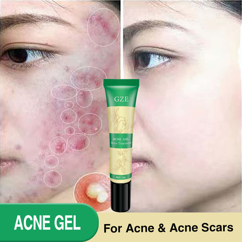 2018-lanbena-acne-treatment-gel-acne-cleanse-cream-blackhead-remover