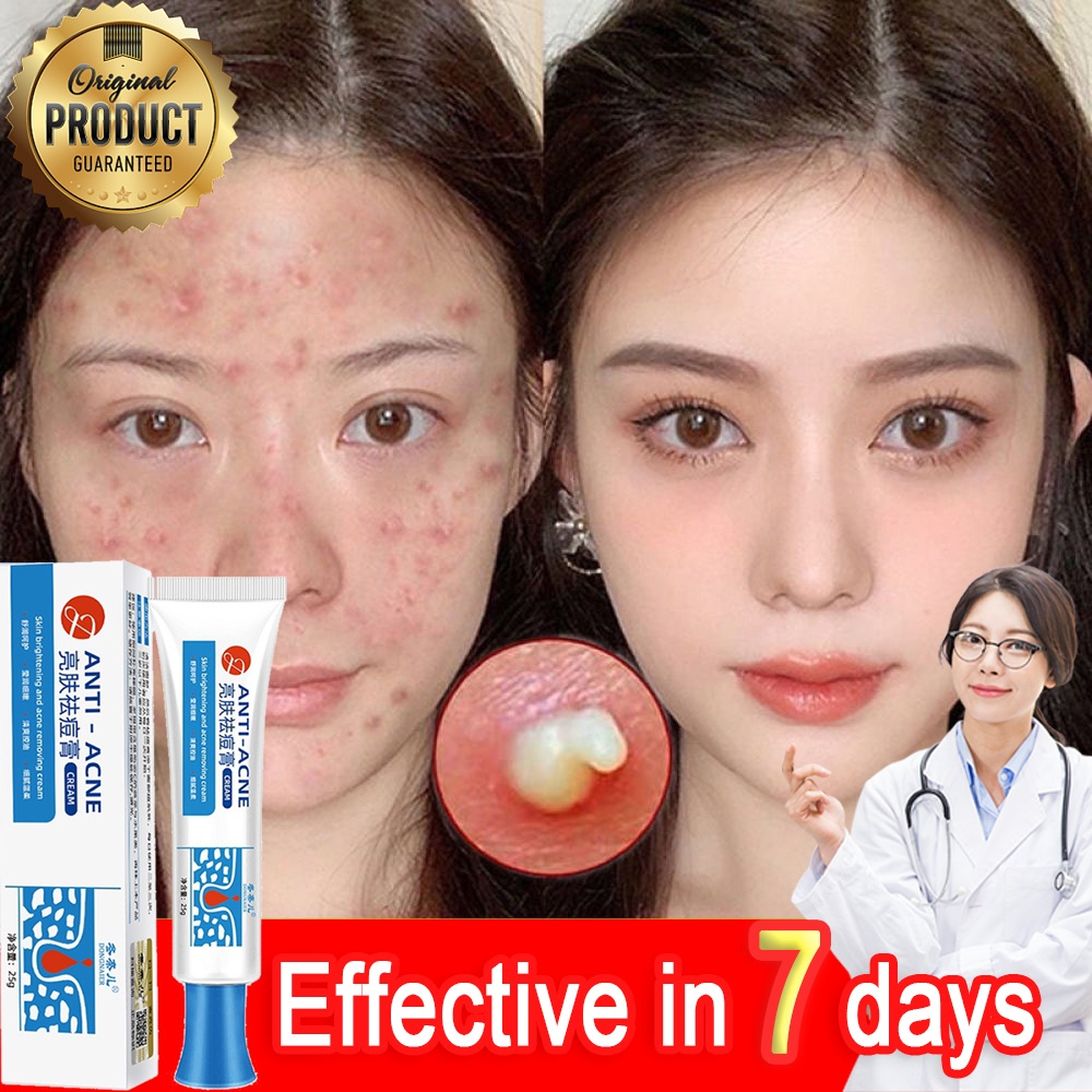 Pimple Remover Cream Acne Removal Scar Marks Cream Acne Treatment Skin