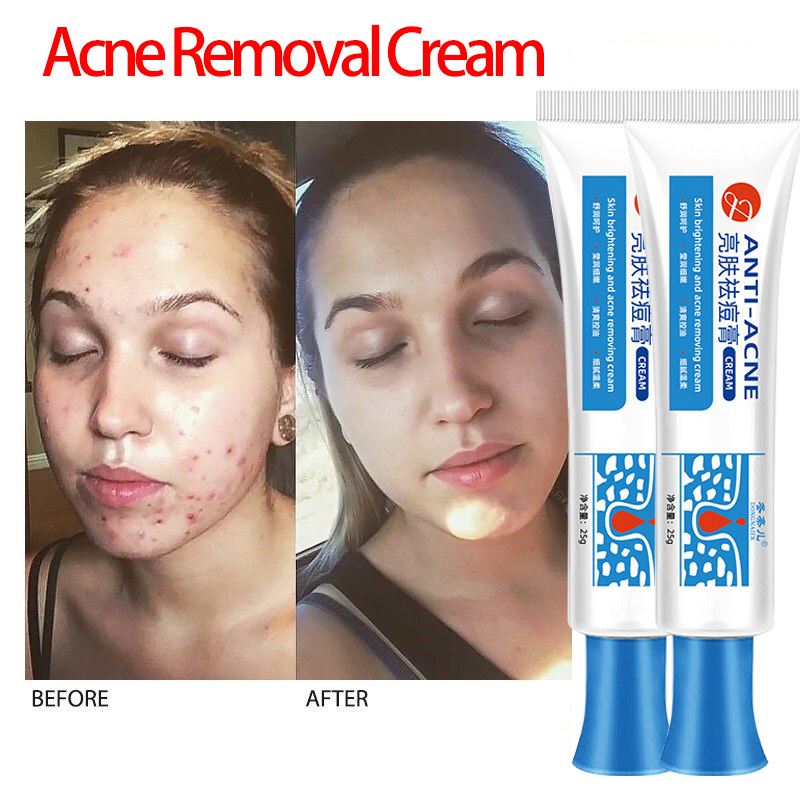 Anti Acne Cream Acne Remover Eraser Pimple Marks Remover Cream Acne