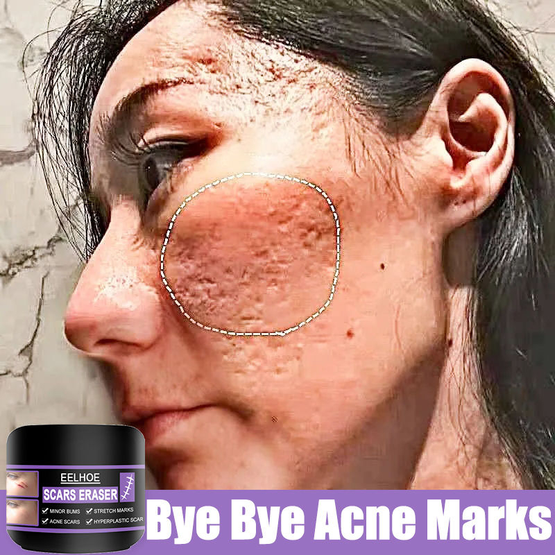 YANJIAYI 50g Scar Removal Cream Peklat Remover For Old Scars Stretch Marks Repair Treatment