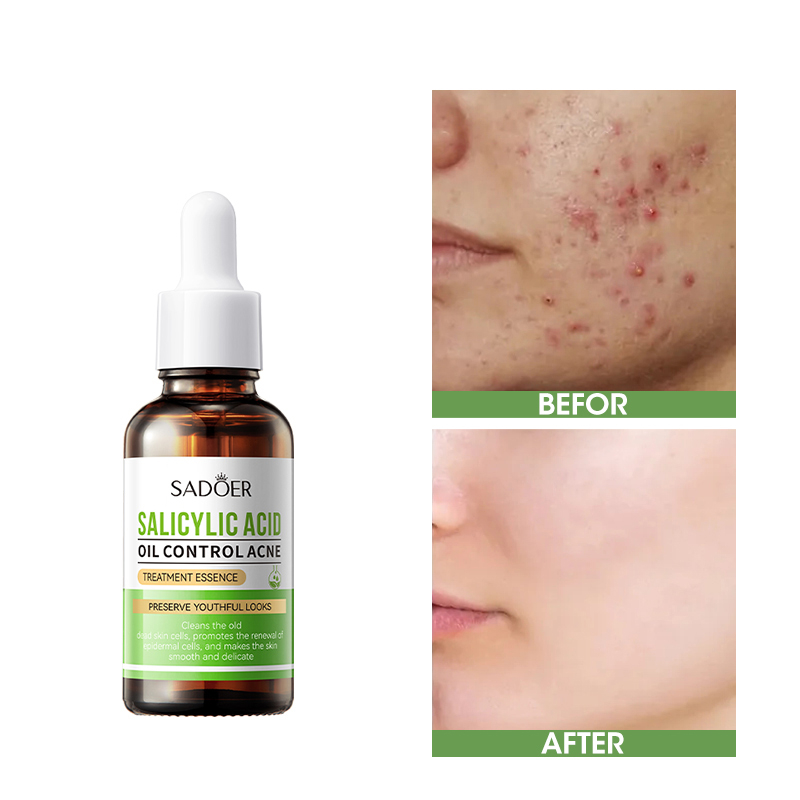 Salicylic Acid Face Serum for Acne Oil Control Pimple Spot Treatment Acne Scar Removal Essence