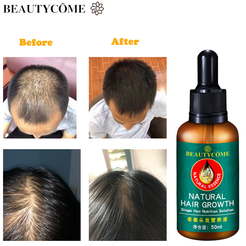 Youngcome Hair Growth Essence Anti Hair Loss Liquid Fast Hair Grower Treatment Prevent Baldness 7884