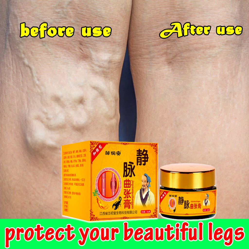 100g varicose veins cream/varicose veins treatment/varicose vein