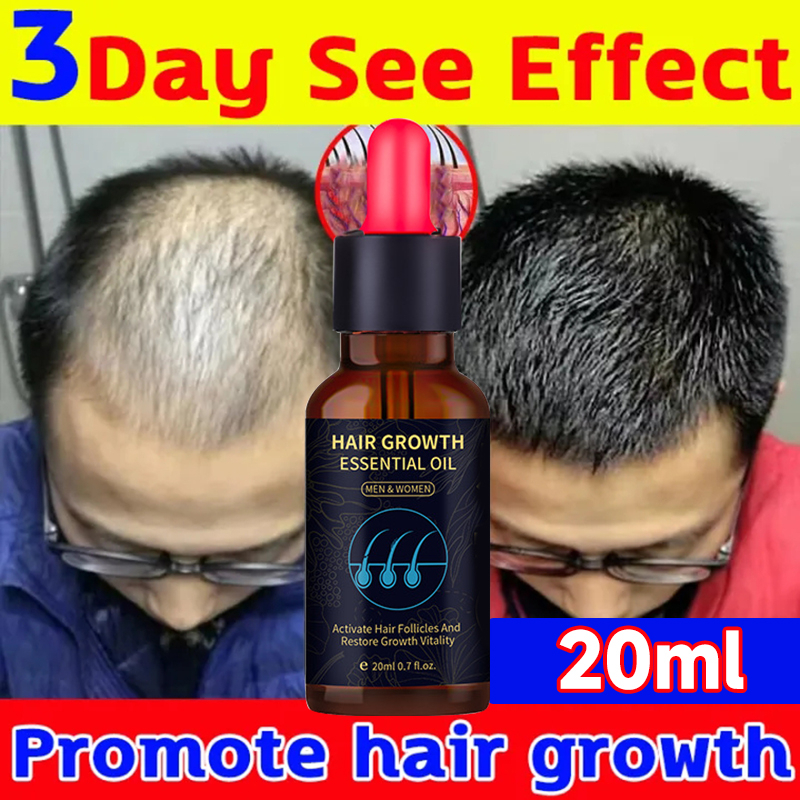 YANJIAYI Minoxidil 5% Hair Growth Essential Oil Ginger Hair Nutrient ...