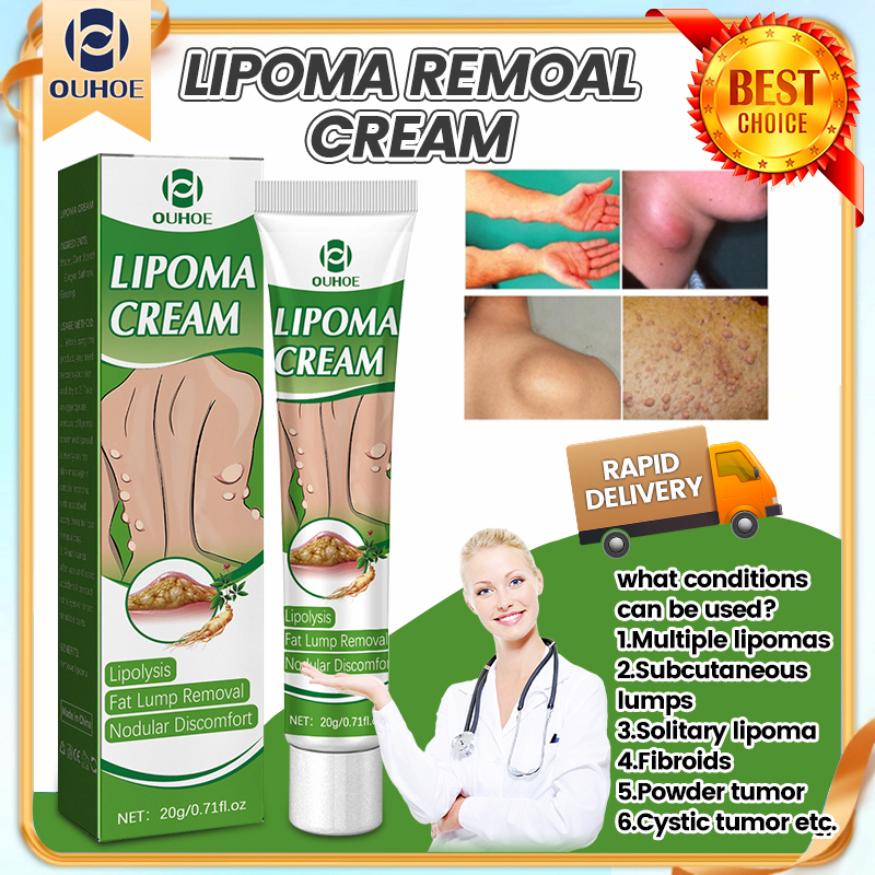 Lipoma Removal Cream original lipoma ointment Treat Tumor Skin Swelling ...