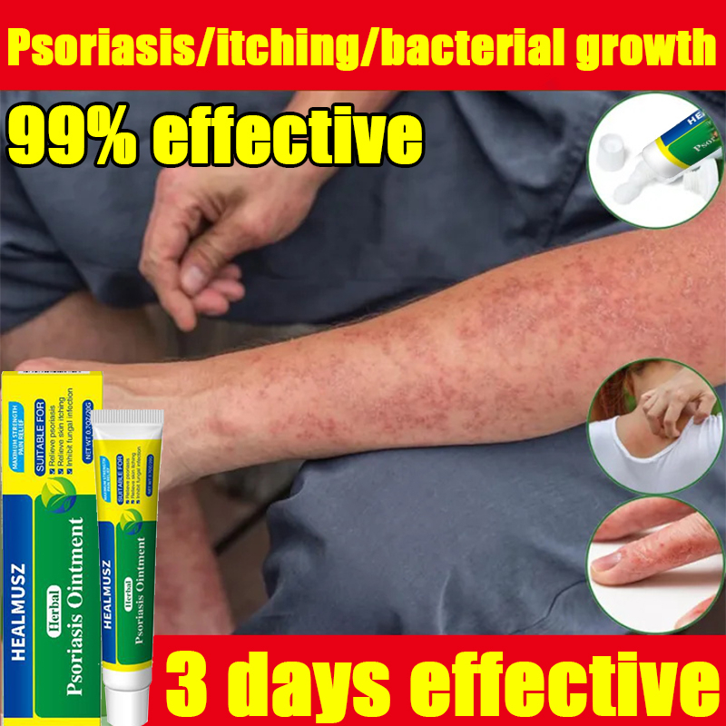 Anti fungal cream 20g itching ointment dermatitis Eczema cream Relief Skin Rash Urticaria