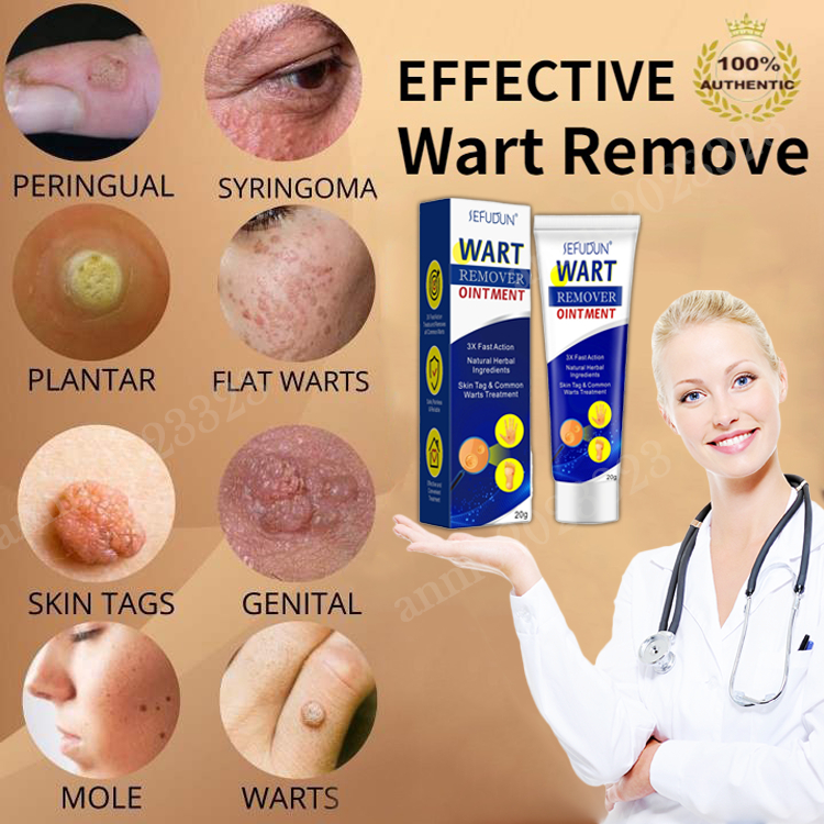 wart cream 20g Warts Cream Skin Remover Warts Remover wart removal
