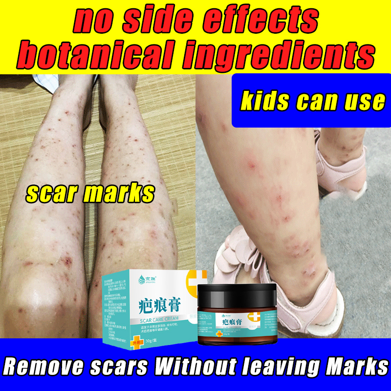 JINGSHENG Old Scar Removal Cream for Leg 30g Children can use Peklat