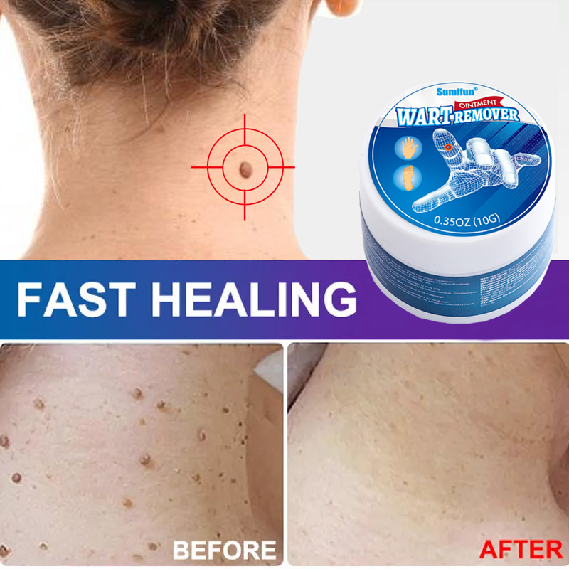 Warts Remover Ointment Cream Effectively Remove Foot Corns Skin Tags