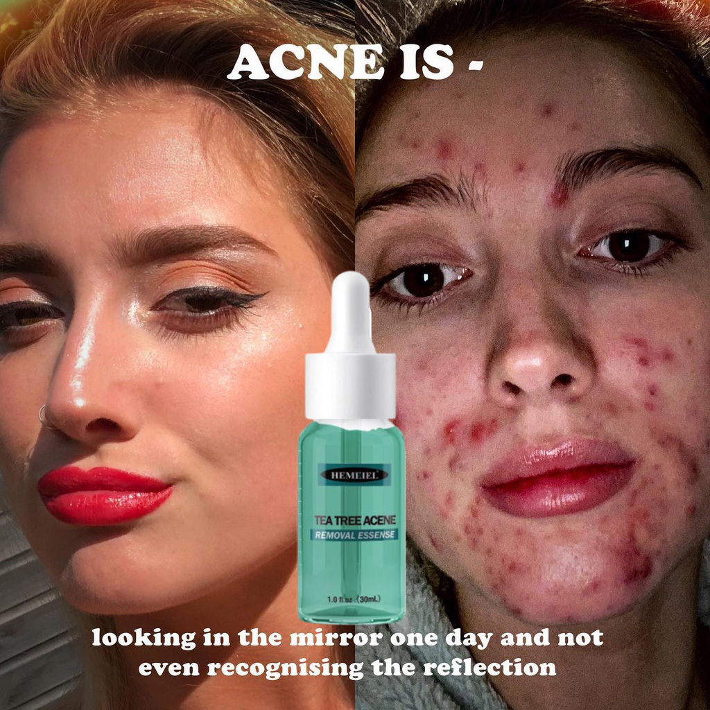 HEMEIEL Acne Serum / Acne Scar Remover/Acne Scars Removal Facial /Acne