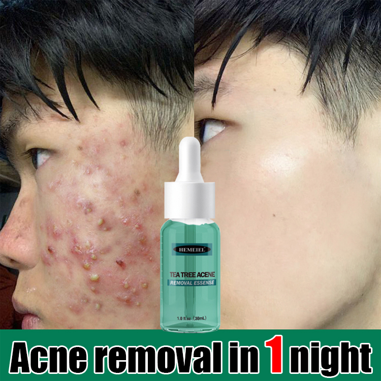 HEMEIEL Acne Treatment Serum, Adapalene, Pimple Remover, Anti Acne, Oil