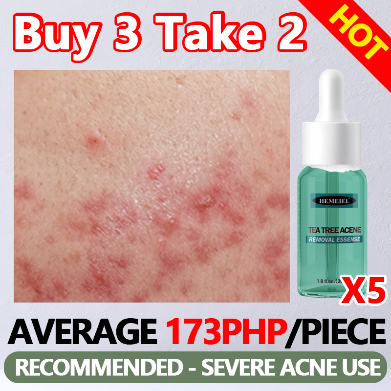 HEMEIEL Acne Treatment Serum, Adapalene, Pimple Remover, Anti Acne, Oil