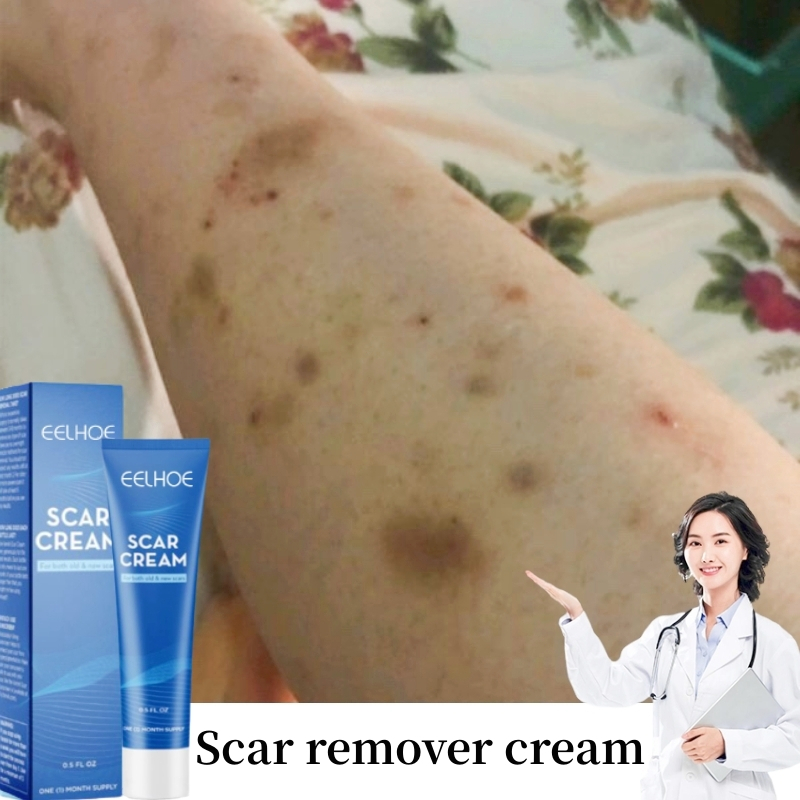 scar-remover-cream-mosquito-bite-scar-remover-keloid-scar-cream-remover