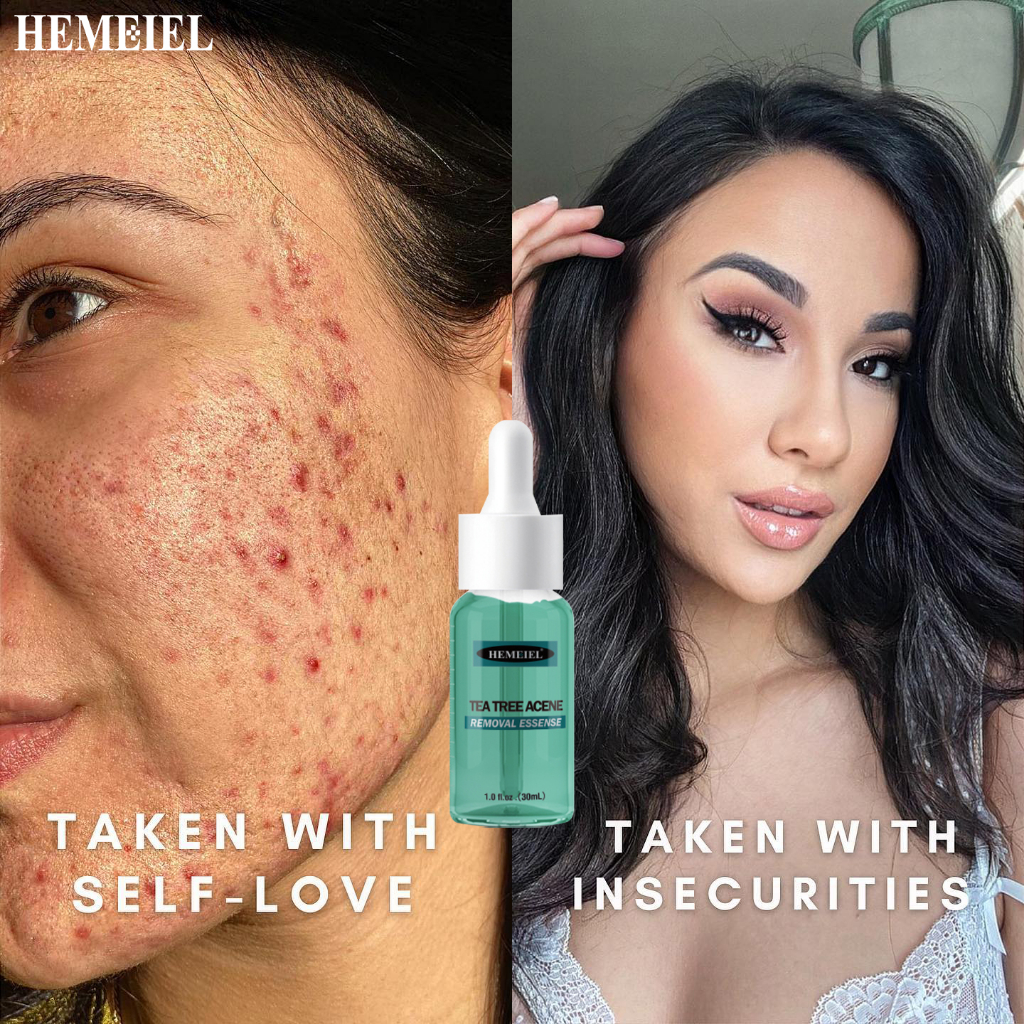 HEMEIEL Acne Treatment Serum/Adapalene 0.1/Pimple Remover/Anti Acne