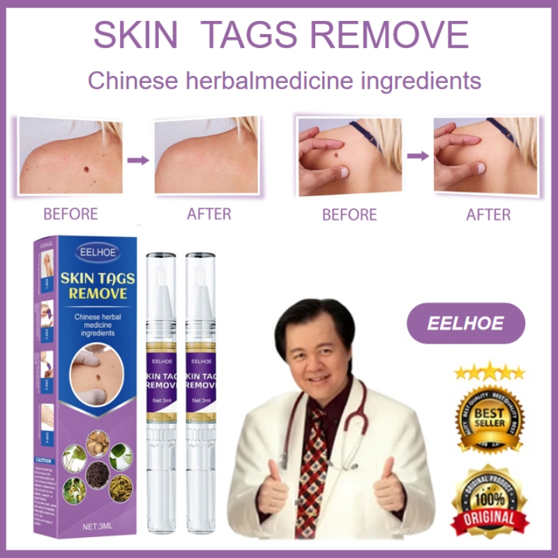 ORIGINAL Wart and Mole Remover Facial Skin Tag Removal Pen Foot Corn