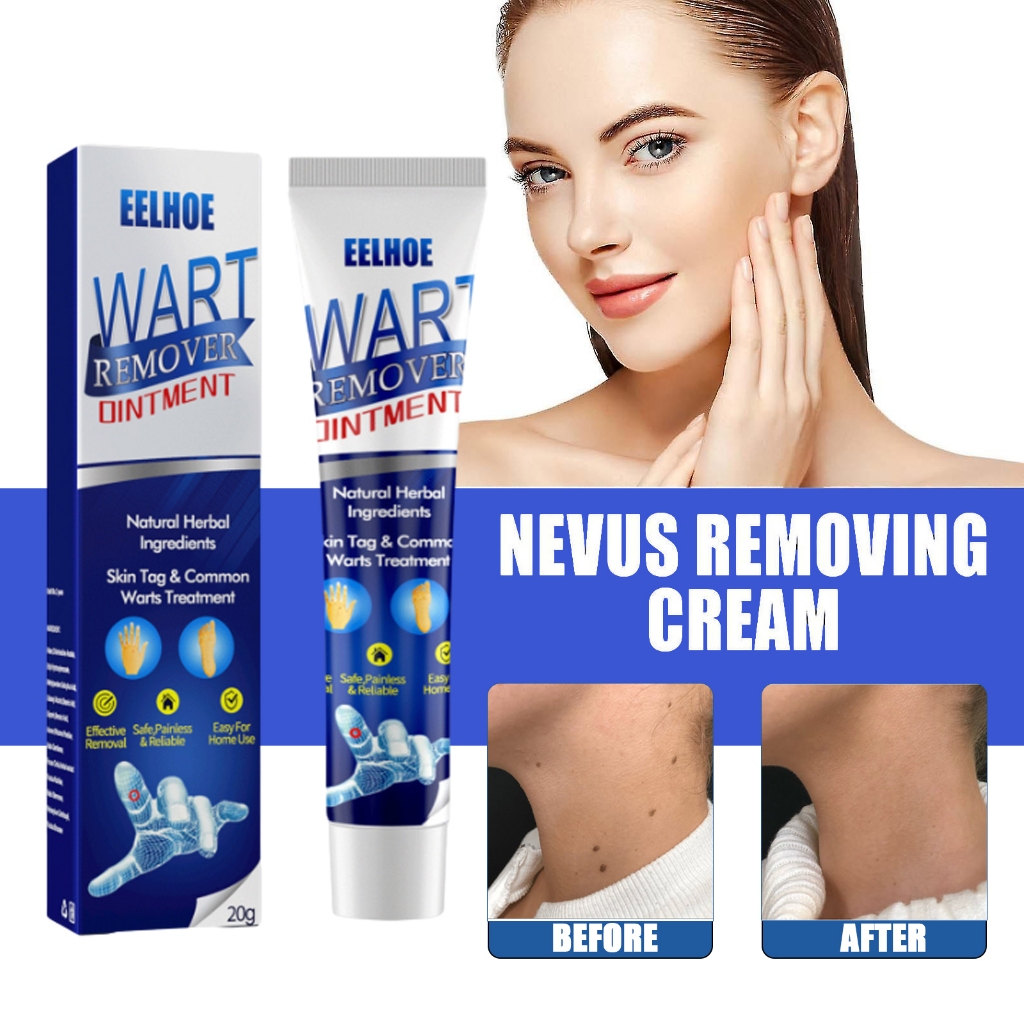 【Fast Delivery】Warts Remover Cream Foot Corns Remover Cream Calluses On