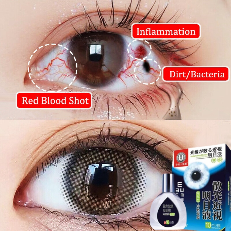 Eye Problems Therapy Eye Drops eyesight-improving eye drops Cure sore ...