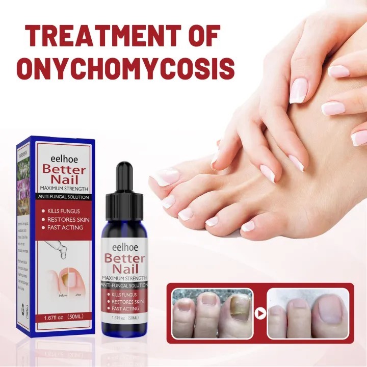 South Moon Nail Fungus Repair Pen Remove Onychomycosis Paronychia Reduce Toe Infection Brighten Nail Hand Foot Nail Care Liquid