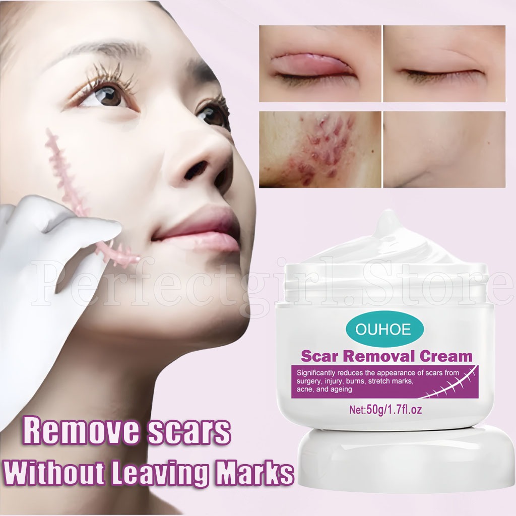 Scar Remover Cream Old Scar Remover Cream For Legs Peklat Remover ...